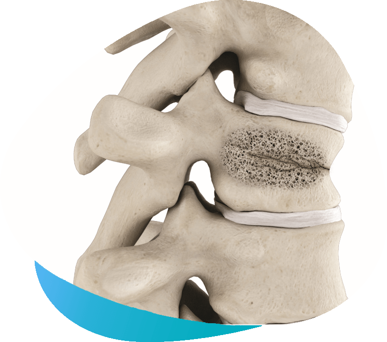 Treating Your Compression Fracture with Kyphoplasty: The Spine Institute of  Southeast Texas: Orthopedic Surgeons