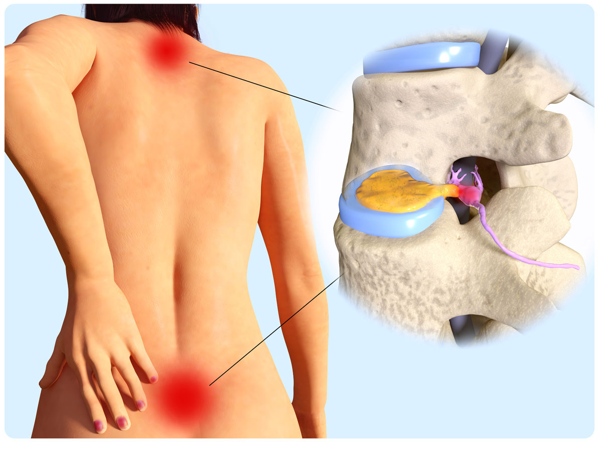 Pinched Nerve in Lower Back: Causes, Symptoms, and Treatments